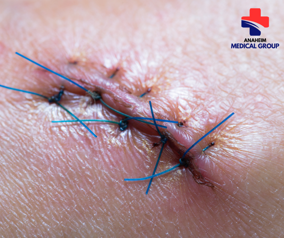 Minor Cuts and Wounds in Anaheim – Treatment and Care — image 3